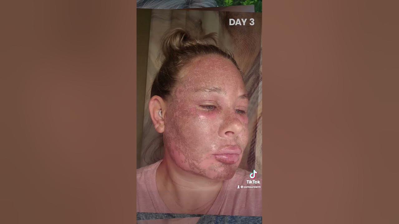 She LOVED Her CO2 Laser!