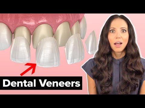 Video: Veneers zimewekwaje?