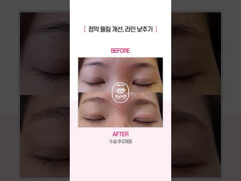 점막 들림 개선 및 라인 낮추기 리얼 후기 #shorts #강남서연 #강남서연성형외과 #점막들림 #점막들림개선 #라인낮추기 #쌍수 #쌍수라인 #ㄱㄴㅅㅇ