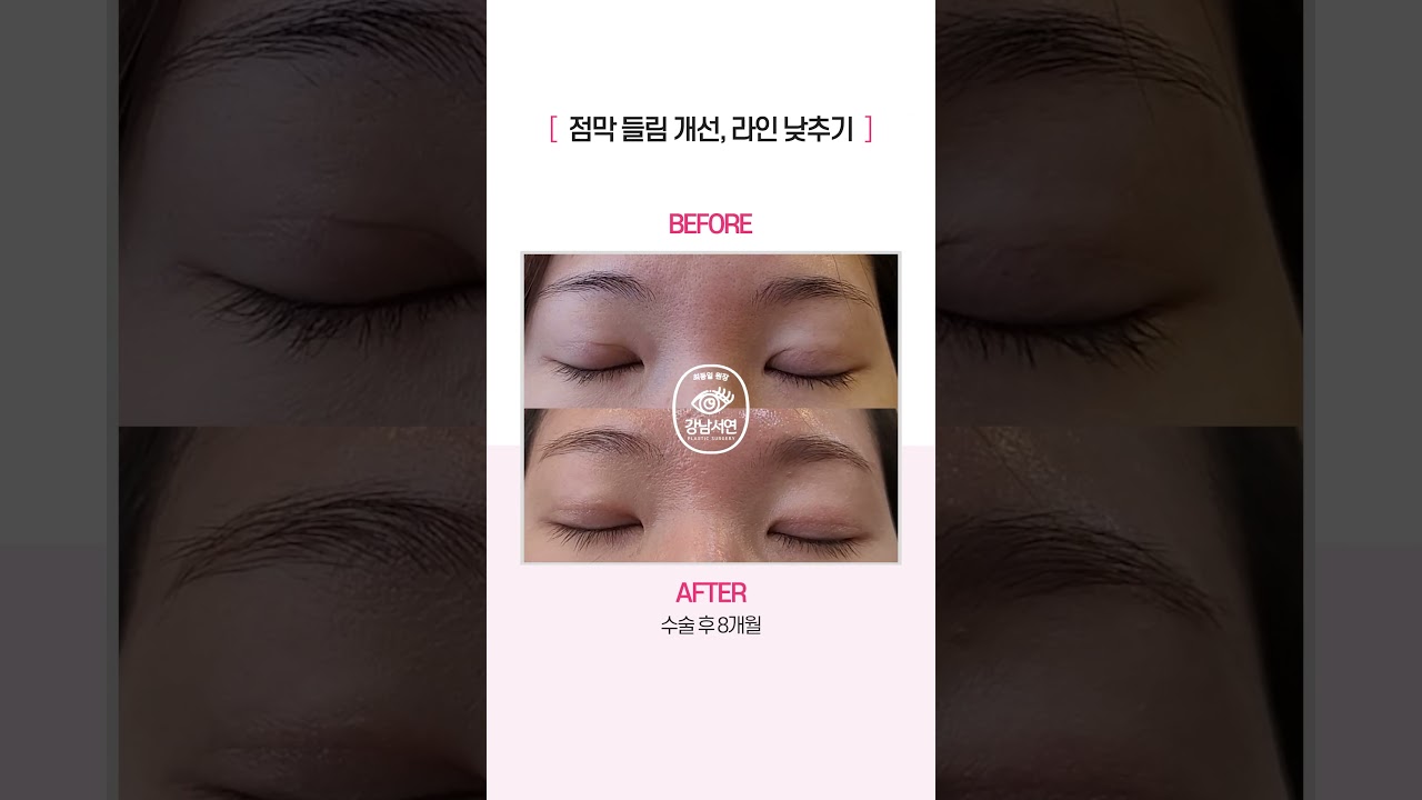 [Ганнам Соён гоо сайхны мэс заслын эмнэлэг] давхрааны салст бүрхүүл ил харагдахыг сайжруулах, шугамыг намсгах тухай бодит сэтгэгдэл #шортс #ГаннамСоён #ГаннамСоёнГооСайхныМэсЗаслынЭмнэлэг #давхрааны_салст_ил_харагдах #давхрааны_салст_ил_харагдахыг_сайжруулах #шугам_намсгах #давхраа_хийлгэх #давхрааны_шугам #гнсо