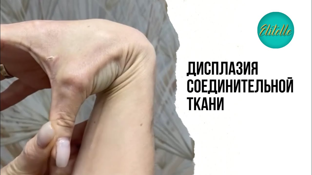 Дисплазия соединительной ткани 👍