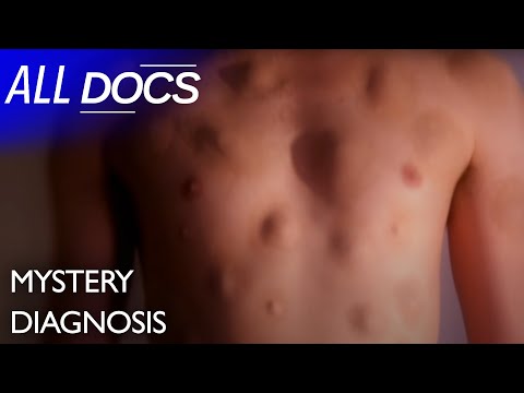 The Man With Hundreds of Lumps - Lipomas | Medical Documentary | Reel Truth