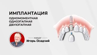 Что такое одномоментная, одноэтапная, двухэтапная имплантация