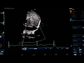 IVC view  usual and unusal view