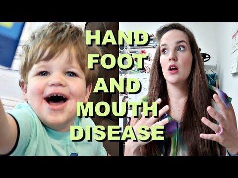 how-to-survive-hand-foot-and-mouth-disease