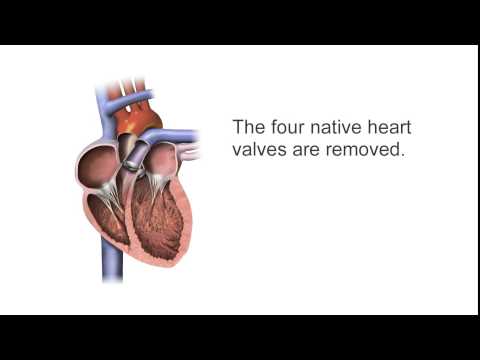 SynCardia Total Artificial Heart Surgical Progression Animation