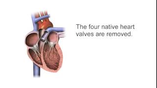 SynCardia Total Artificial Heart Surgical Progression Animation