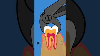 Extraction of Broken Root Piece  #drteeth #dentistry