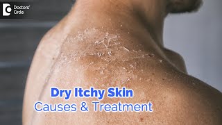 Dry itchy skin all over body. Causes, Diagnosis, Treatment - Dr. Rashmi Ravindra  | Doctors' Circle