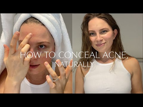HOW TO COVER UP ACNE & SCARS, NATURALLY