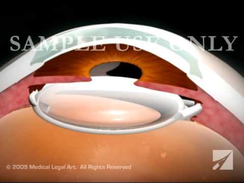 Eye Surgery- Cataract with Lens Replacement