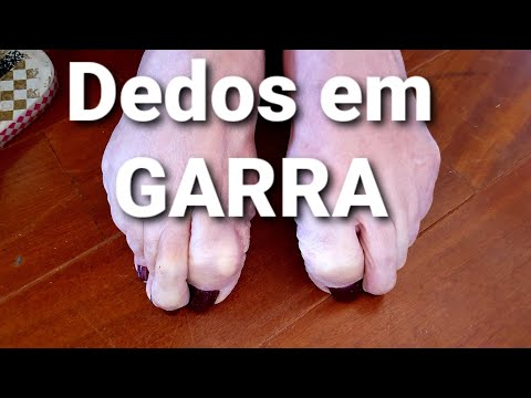 Vídeo: Pé De Garra: Identificação, Causas E Tratamentos