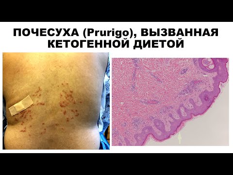 ПОЧЕСУХА (Prurigo), ВЫЗВАННАЯ КЕТОГЕННОЙ ДИЕТОЙ