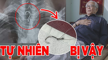 Khó hiểu cụ ông vướng lưỡi câu trong thực quản nhưng lại không biết vì sao