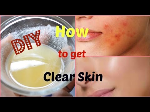 DIY Face Mask to Get Rid of Acne & Acne Scars FAST!! 💯% Natural🌿 No more Acne Prone Skin💞