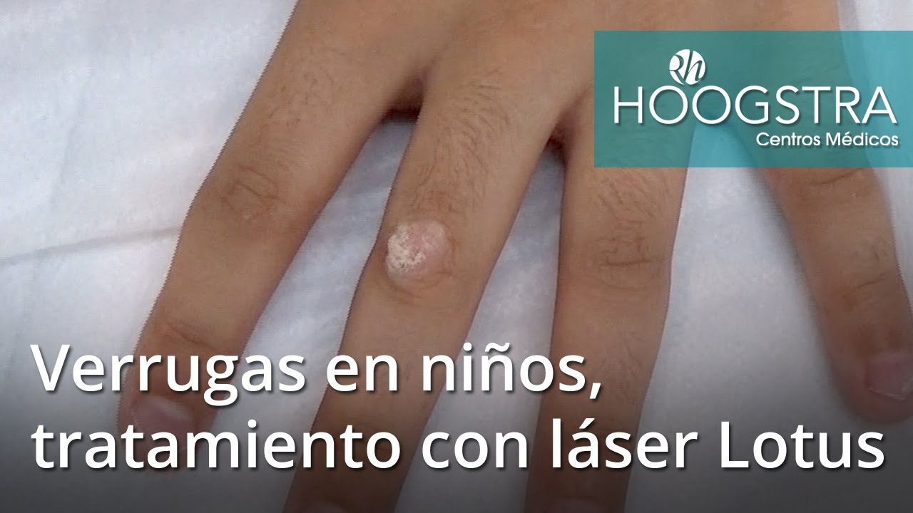 papiloma humano Verrugas en niños, tratamiento con láser Lotus (16039)