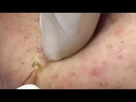 THE MOST SATISFYING GIANT BLACKHEADS REMOVAL APRIL 