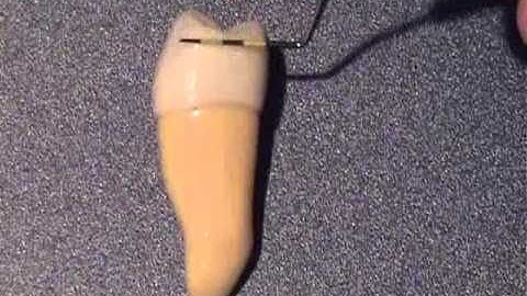 Mandibular 2nd premolar anatomy