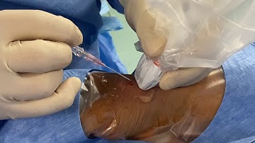 ECHO-Guided Distal Radial Artery Puncture