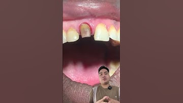 Làm răng giả như thế nào? Cách làm răng giả #nhakhoa #rang