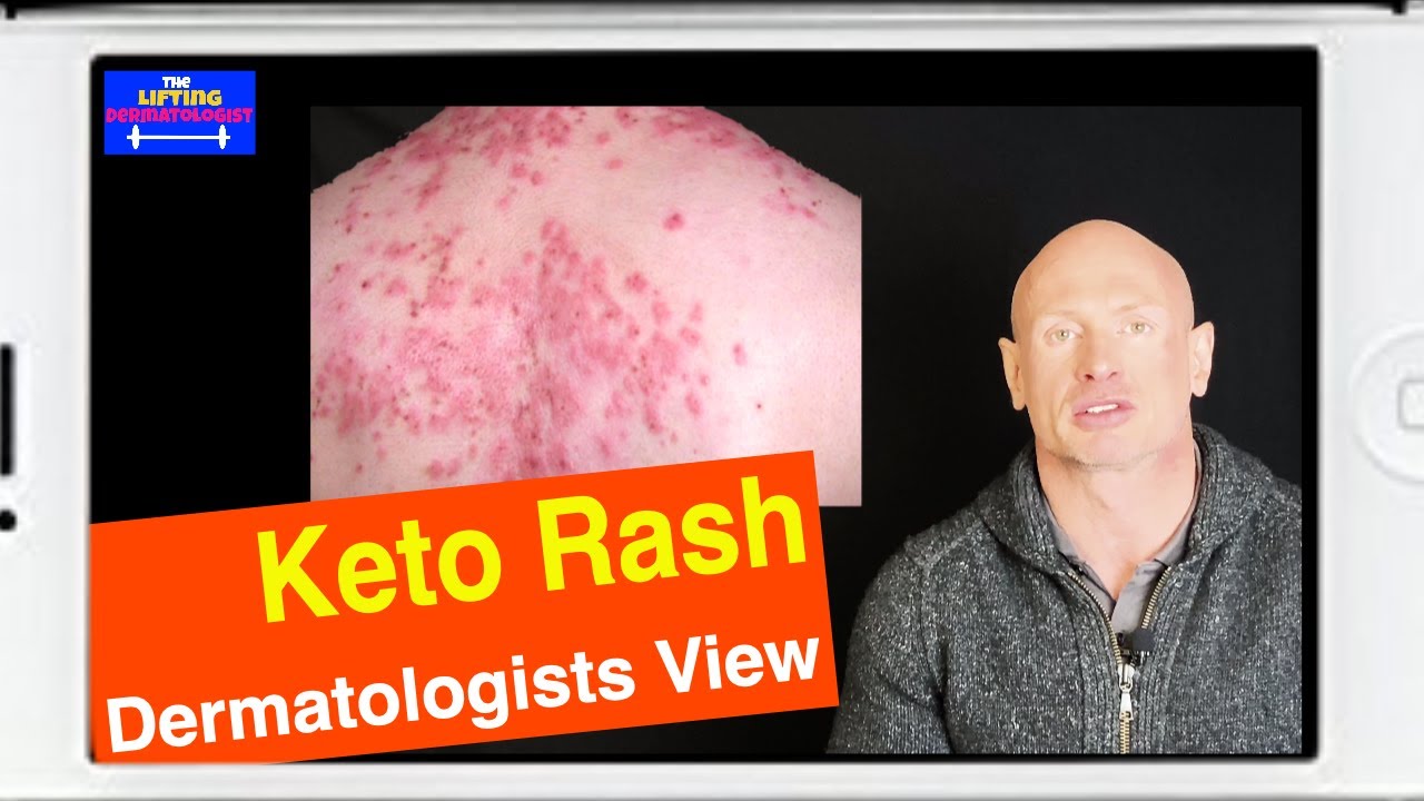 Keto Rash Ketogenic Rash Dermatologists View Youtube