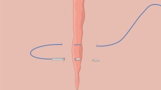 Surgical Skills: Horizontal mattress suture.