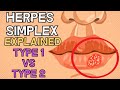 Herpes Simplex - Type 1 vs Type 2 - EXPLAINED IN 2 MINUTES