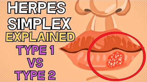 Come diagnosticare herpes simplex?