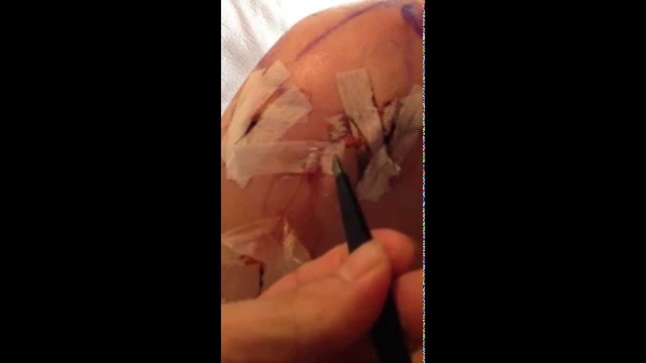 How to remove pain pump after shoulder arthroscopy YouTube
