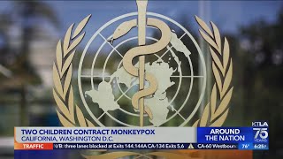 2 children, 1 in CA, diagnoses with monkeypox
