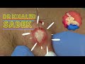 Explosive Back Cyst. Dr Khaled Sadek. LipomaCyst.com
