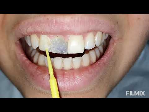 Ön tek diş eksikliğinin kesimsiz implantsız acısız tek seansta fiber köprü ile tamamlanması