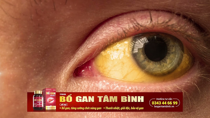 Mắt vàng là biểu hiện của bệnh gì năm 2024