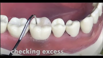 complex composite restoration on 46 plus full assessment