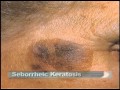 Common Skin Lesions