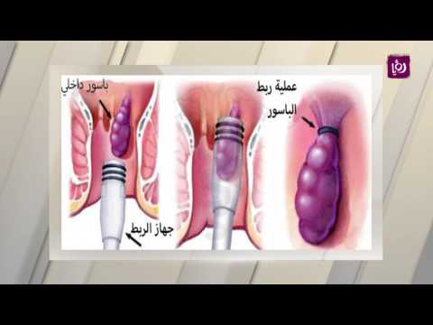 د. عمرمنصور - النزيف الشرجي أسبابه وطرق علاجه - طب وصحة