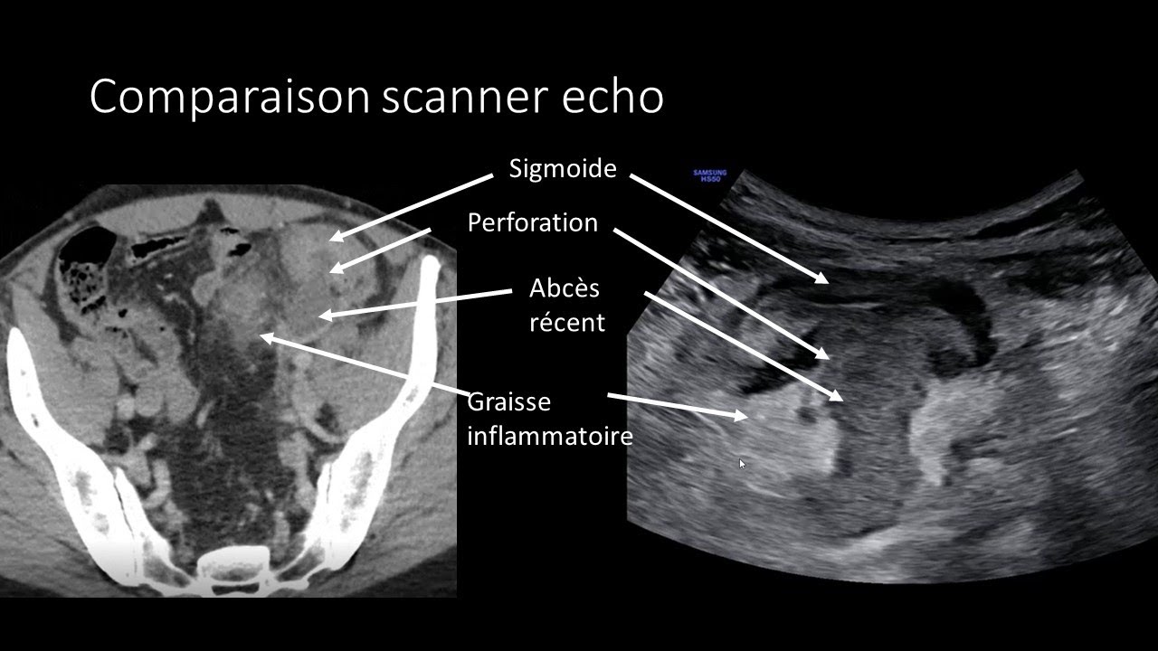Echographie digestive Diverticulite perforée abcès Diverticulitis Abcess ultrasound