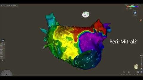 Figure 8 Mitral and Roof flutter