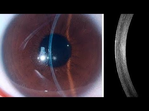 Corneal layers |