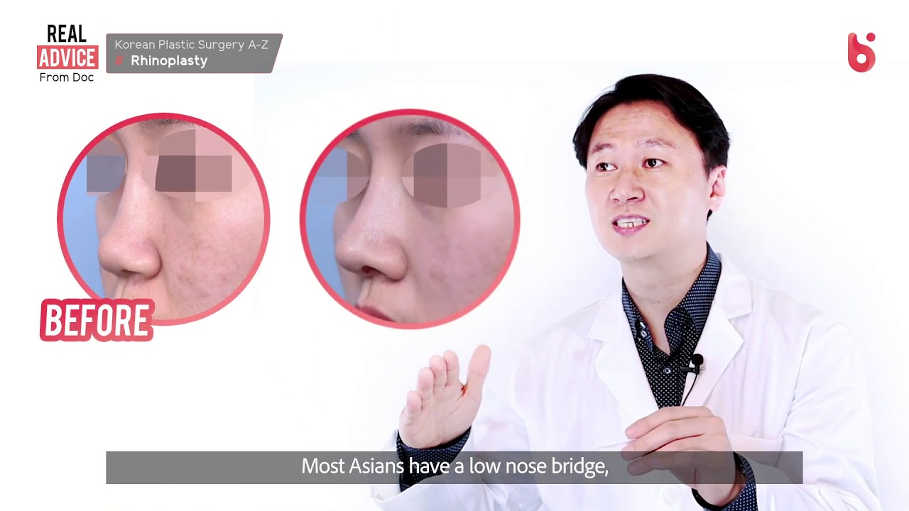 [Бэрригүүд Гоо Сайхны Мэс Заслын Эмнэлэг] Хамарны мэс засал сонирхож байна уу? Гоо сайхны мэс заслын Асуулт Хариулт. Хамарны мэс засал хийлгэх хүмүүс заавал уншаарай!!