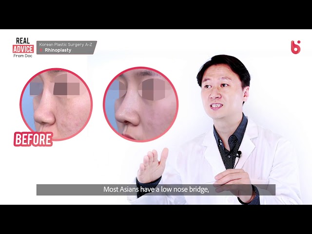 코 수술이 궁금하다면? 성형 Q&A 코수술할 사람 필수!!