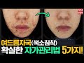 제발 여드름 염증 생겼을 때 ‘이것’ 좀 하지마세요! #여드름자국 #여드름색소침착 확실한 예방법