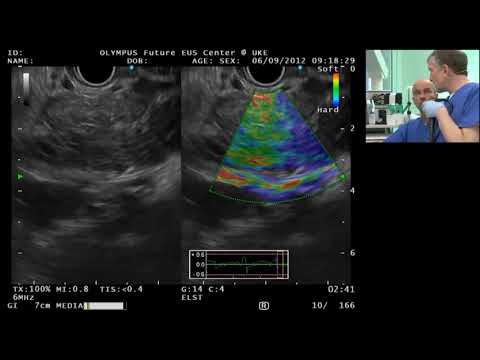 EUS in a patient with chronic pancreatitisand dilation of the pancreatic duct