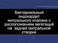 Бактериальный эндокардит с поражением задней митральной створки