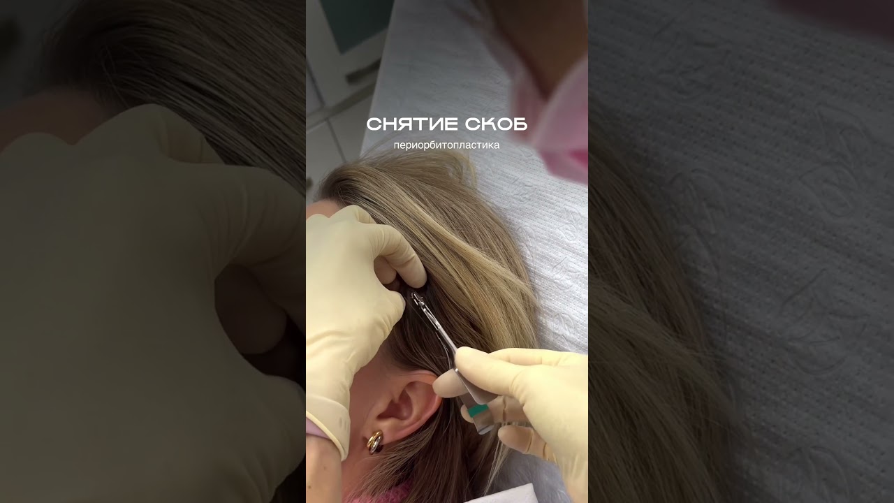 Окончательный результат формируется постепенно — в течение 3–6 месяцев 