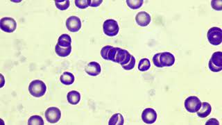 Rouleaux formation in blood smear