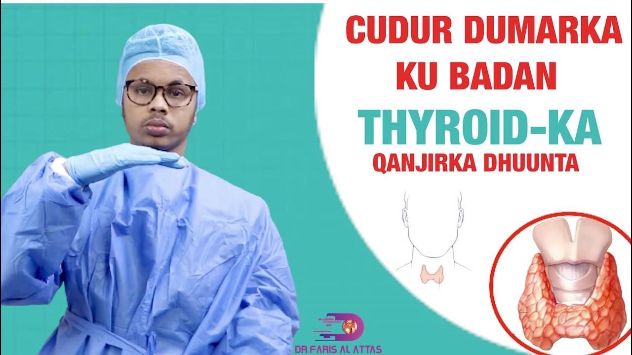 CUDUR DUMARKA AAD UGU BADAN OO KU DHACA 𝐐𝐀𝐍𝐉𝐈𝐑𝐊𝐀 𝐃𝐇𝐔𝐔𝐍𝐓𝐀 EE THYROID-KA. DrfarisAlattas