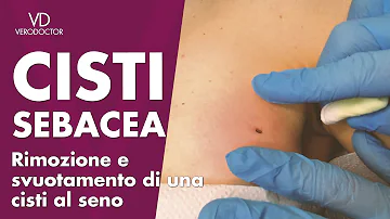 Come eliminare le cisti sebacee?