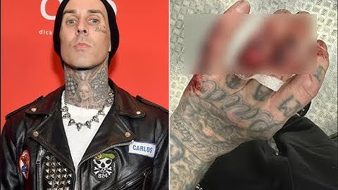 Travis Barker shows off his latest gruesome hand injury after a Blink-182 concert
