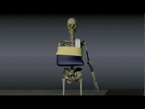 Reducing a Dislocated Shoulder